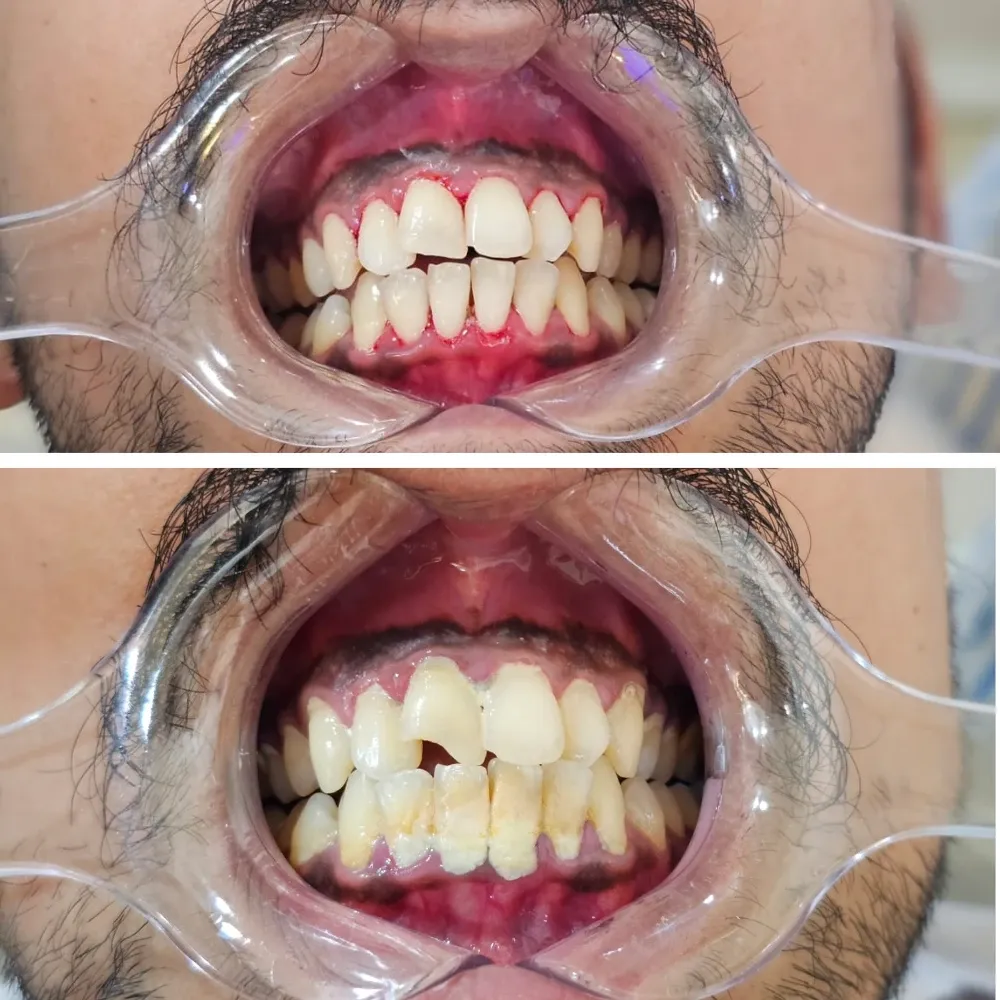 Smile transformation from cosmetic bonding treatment at The Elegant Dentistry